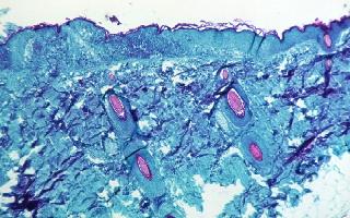 explained-reason-behind-spike-in-monkeypox-cases-and-how-can-people-protect-against-infection