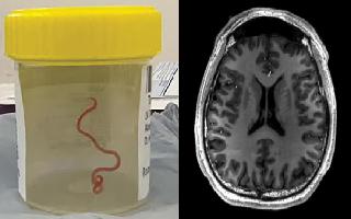 live-roundworm-found-inside-64yearold-womans-brain-in-australia-becomes-first-of-its-kind-discovery