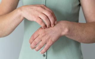 How To Treat Fungal Infection At Home: 5 Effective Ways To Get Rid Of It Naturally