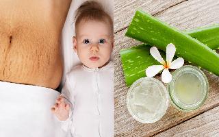 want-to-get-rid-of-stretch-marks-naturally-try-these-5-aloe-vera-masks