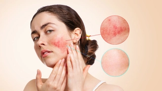 Expert Explains Why Sensitive Skin Needs Special Care? Guide To Manage Sensitive Skin