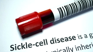 World Sickle Cell Day 2024: Expert Explains About What Are The Actually Triggers Of A Sickle Cell Pain