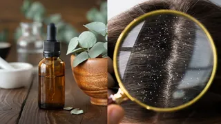 5 Essential Oils To Add To Your Haircare Regime To Prevent Dandruff And Flaky Scalp