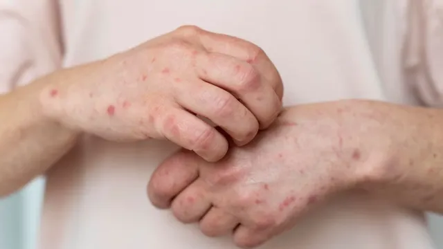 mpox-outbreak-how-does-it-spread-from-person-to-person-expert-lists-early-symptoms-to-watch-out-for