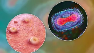 India Reports First Suspected Mpox Case, Patient Put Under Isolation; Here's What Health Min Said