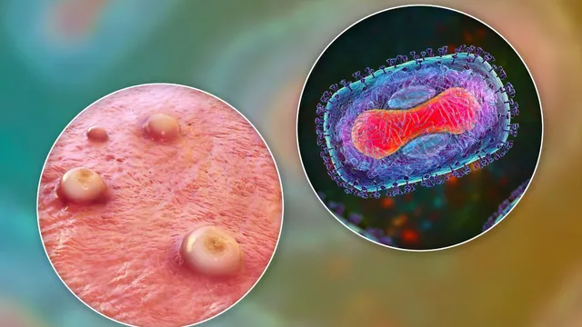 mpox-cases-in-india-health-ministry-response-contact-tracing-isolation-monkeypox-symptoms-prevention-other-details
