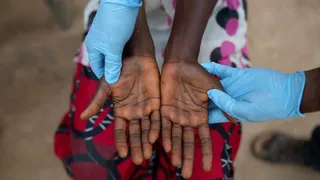 Mpox In India: Centre Asks States To Ramp Up Screening, Testing And Surveillance; Check Complete Guidelines