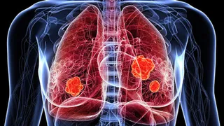Know From Expert About What Is Hypersensitive Pneumonitis And What Is Its Role, Specially In Lung Diseases
