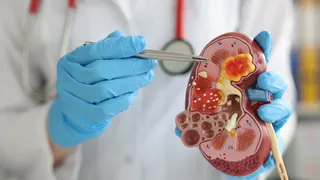Can Kidney Stones Cause Cancer? Here's What Expert Has To Say