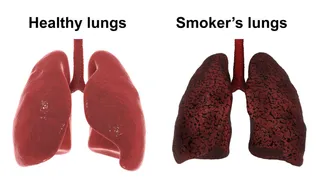 Keeping Your Lungs Healthy: Know From Expert About All The Essential Habits For Optimal Function