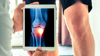 Doctor Explains How Regenerative Medicine Helps To Restore Mobility And Quality Life In Osteoarthritis Patients
