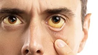 Can Jaundice Be A Sign Of Pancreatic Cancer? Doctor Lists Major Signs and Symptoms To Watch Out For
