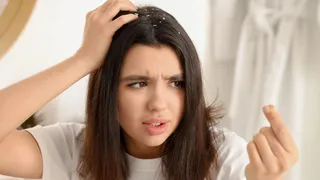 winter-haircare-4-easy-ways-to-eliminate-dandruff-from-your-scalp