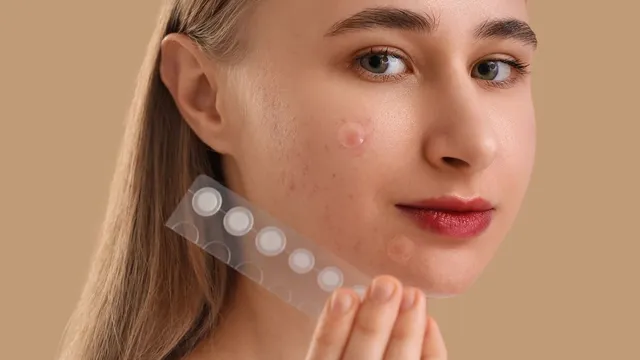 what-is-pimple-patch-know-the-benefits-and-usage-of-the-sticker-that-fights-acne