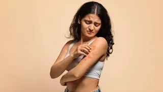 Effective Home Remedies To Relieve Rashes And Itching Easily