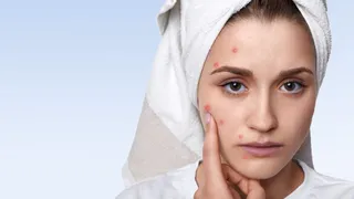 Why Adult Acne Is Rising? Cosmetologist Shares Tips To Treat It Naturally