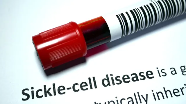 why-sickle-cell-disease-needs-policy-priority-and-public-compassion-know-from-doctor