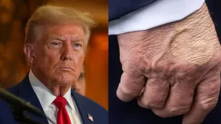 donald-tump-mysterious-hand-bruise-covered-with-flesh-toned-color-goes-viral-after-fifa-final