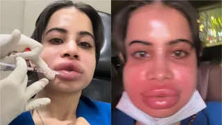 Urfi Javed Looks Unrecognisable After Dissolving Lip Fillers, Says 'Will Get Them Again' | SHOCKING VIDEO