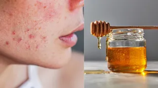 Heal Scars With Top 5 Ingredients From Your Kitchen To Get Clearer Skin