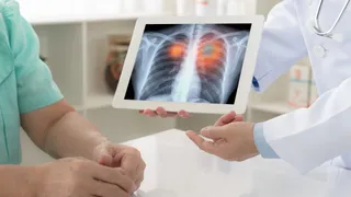 Lung Cancer In Young Adults: Signs, Risk Factors And How To Detect It Early | Insights From Doctor