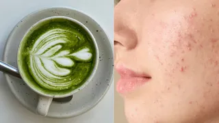 How Anti-Inflammatory Benefits Of Matcha Support Acne-Prone Skin? Dermatologist Explains