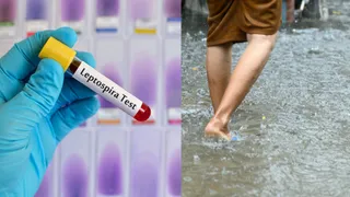What Is Leptospirosis? Doctor Shares Causes, Treatment And Prevention Of Hidden Monsoon Danger