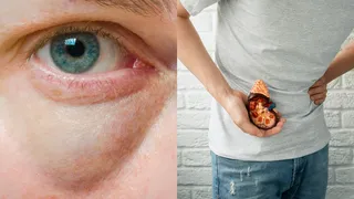 Kidney Disease Symptoms On Face And Neck: Doctor Shares Early Warning Signs That You Shouldn’t Ignore