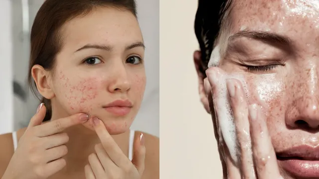 changing-weather-causing-acne-5-skincare-hacks-your-skin-needs-this-season-for-acnefree-glow