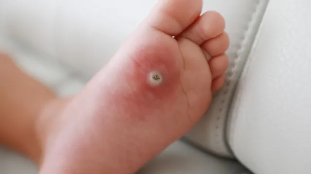 world-diabetes-day-2025-doctor-shares-tips-to-heal-diabetic-foot-diseases-and-ulcers