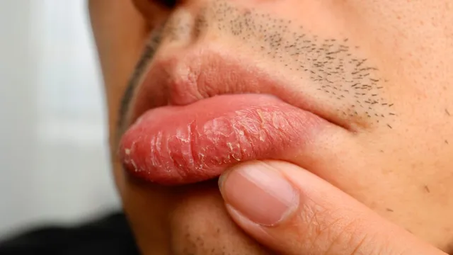 dry-chapped-lips-no-more-get-soft-supple-lips-in-3-days-with-these-7-tips