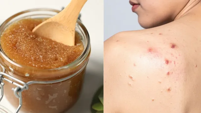 natural-homemade-remedies-for-body-acne-these-5-diy-body-scrubs-to-exfoliate-and-clear-skin