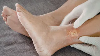 5 Alarming Signs Your Legs Show Before Heart Disease Or Diabetes Strikes; Know From Doctor