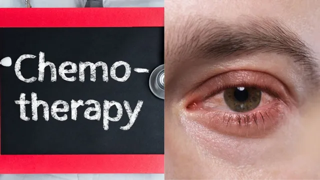 hidden-side-effects-of-chemotherapy-and-radiation-on-eyes-that-no-one-talks-about-know-from-doctor