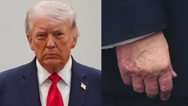 is-donald-trump-suffering-from-dementia-netizens-point-out-unsteady-walk-hand-bruise-and-bald-spot-in-easter-videos