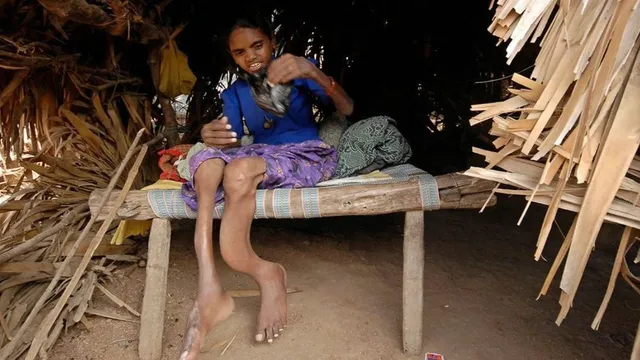 mp-water-crisis-1480-villages-battle-fluorosis-as-safe-water-schemes-fail-children-worst-affected