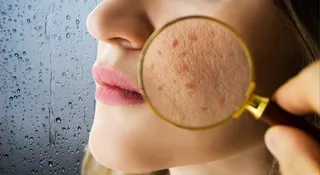 which-ingredients-should-you-avoid-in-monsoon-skincare