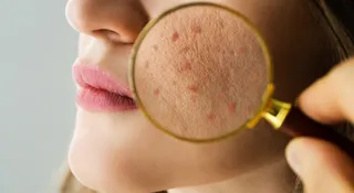 What Does Pimple Location On Your Face Mean?