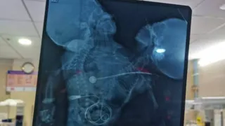 two-heads-two-spinal-cords-one-heart-rare-baby-born-in-odishas-berhampur-condition-critical