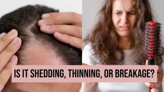 Hair Thinning In Your 20s And 30s: When Is It Normal And When Should You Worry? Dermatologist  Explains